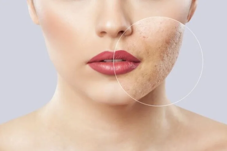 Acne & Acne scar Treatment Mole------12