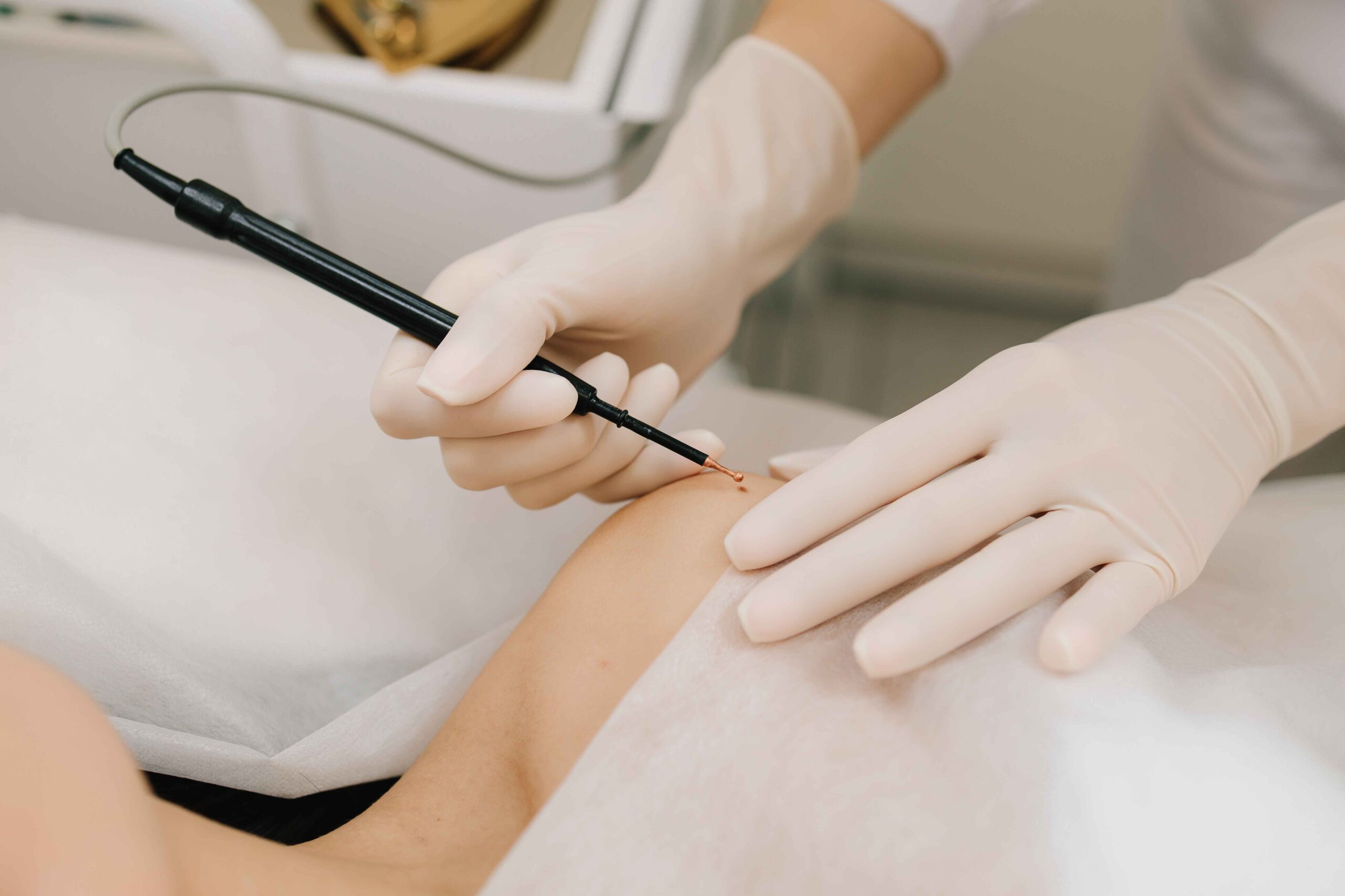 RF Cautery