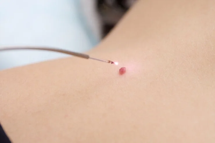 Wart Removal------17